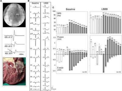 Influence of Left Bundle Branch Block on the Electrocardiographic Changes Induced by Acute Coronary Artery Occlusion of Distinct Location and Duration